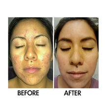Load image into Gallery viewer, SkinSanity® Acne Treatment - Clear Skin Results Regimen