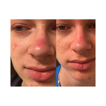 Load image into Gallery viewer, SkinSanity® Acne Treatment - Clear Skin Results Regimen

