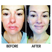 Load image into Gallery viewer, SkinSanity® Dual Action Acne Serum – All-Natural 1 fl oz

