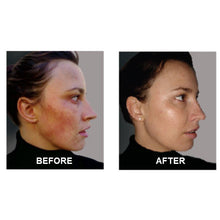 Load image into Gallery viewer, Derm #1 Two-Step Regimen plus FREE Blemish Corrector
