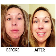 Load image into Gallery viewer, Derm #1 Two-Step Regimen plus FREE Blemish Corrector
